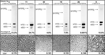 Clinical features and morphology of collagen fibrils in patients with vascular Ehlers–Danlos based on electron microscopy